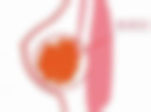 奥美定取出手术的方式有哪些？