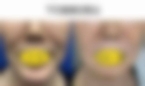 奥美定取出后有哪些风险？