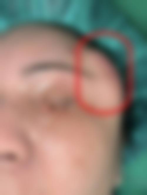 奥美定取出手术价格参考