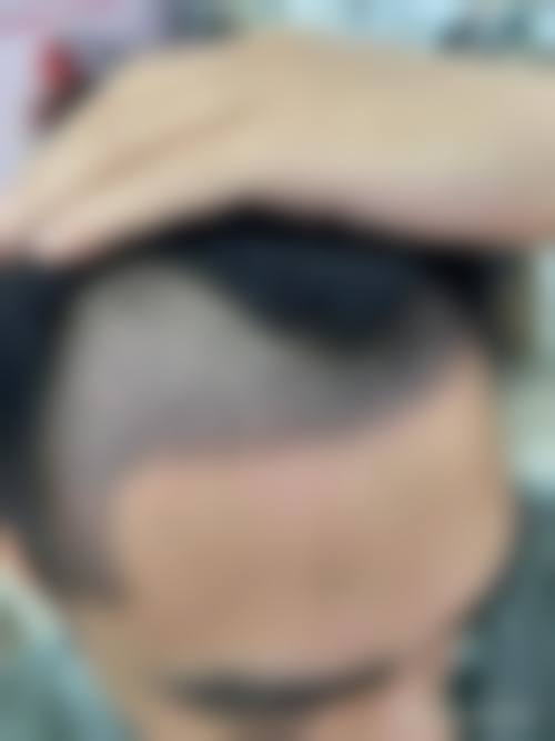 台州大麦微针植发预约挂号方式