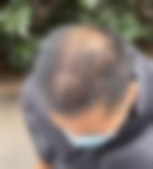 四川成都丝恒植发收费价格表