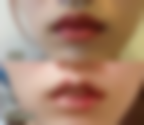 博多痤疮诊所收费价格表