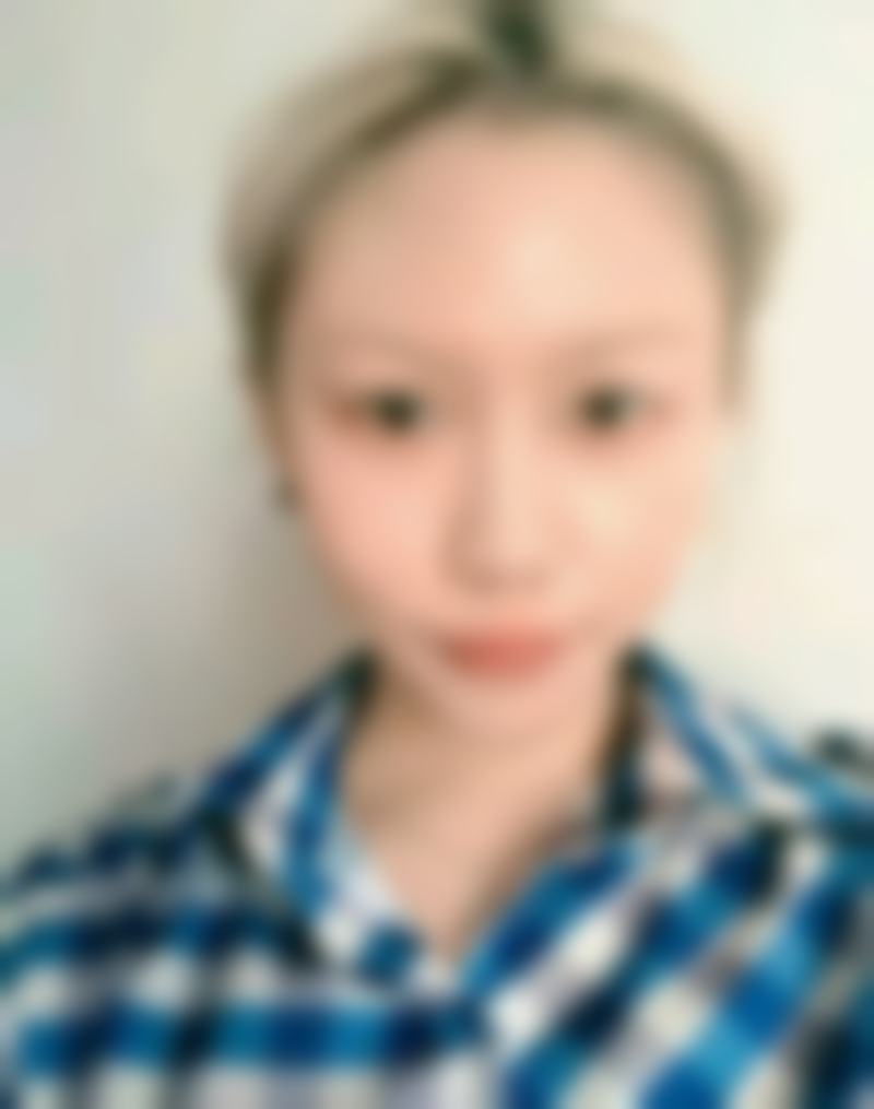 我在广东韩妃割双眼皮成功上岸，自然效果让五官大变样！ 