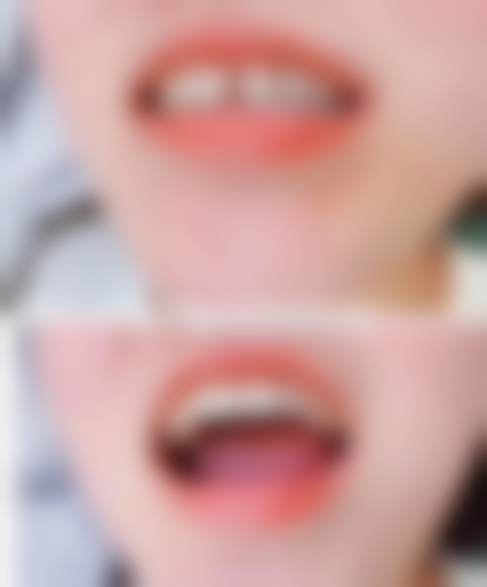 广州壹加壹美容医院广州壹加壹整形美容医院超博瓷贴面效果