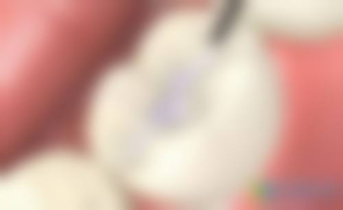 擅长项目详解(美学树脂充填)