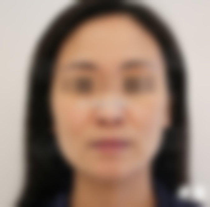 45岁做PSV中下面部提升，我终于和镜子里的自己和解了