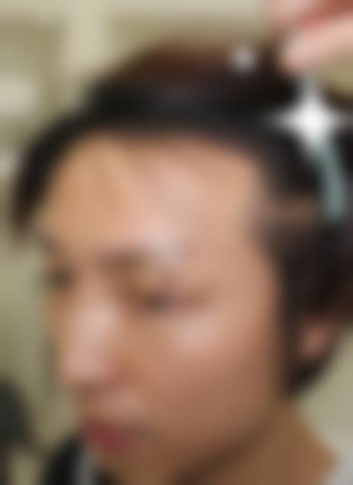 成都新生植发医院收费价格表