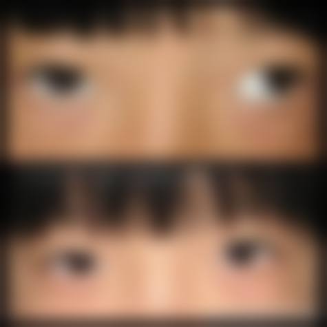 诊疗特色总结 余林青医生 眼科诊疗