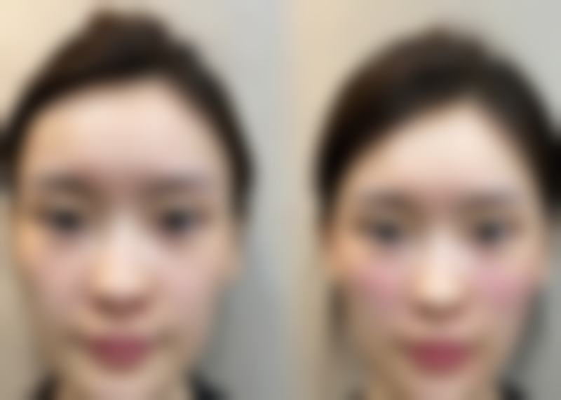 四、临沂赫本医疗美容门诊部的技术优势：创伤小、修复快、更安心